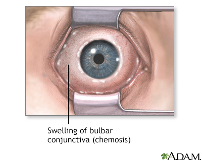 Chemosis Information Mount Sinai New York