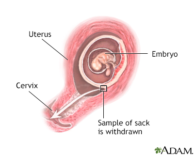 Chorionic villus sampling - Illustration Thumbnail              