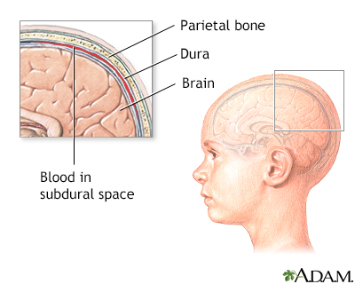 chronic subdural hematoma vs acute