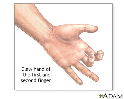 Claw hand