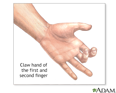 Claw hand Information Mount Sinai New York