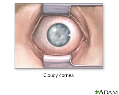 What Causes Cloudy Vision in One Eye?