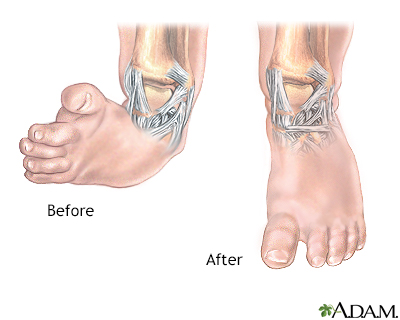 Clubfoot deformity - Illustration Thumbnail
              