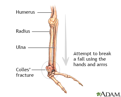 Colles wrist fracture – aftercare Information