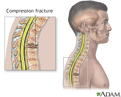 Thoracic Mid Back Pain - Piedmont Physical Medicine & Rehabilitation, P.A.