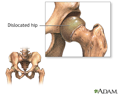 Congential hip dislocation - Illustration Thumbnail
              