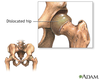 Congenital hip dislocation