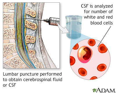 lumbar puncture meningitis