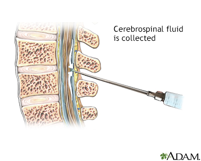 Cerebral spinal fluid (CSF) collection Information | Mount Sinai - New York