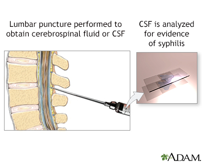 CSF test for syphilis - Illustration Thumbnail
              