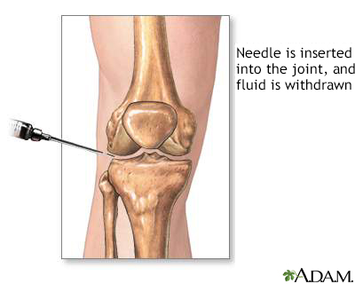 Joint aspiration - Illustration Thumbnail
              