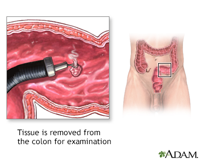 stages of colon polyps