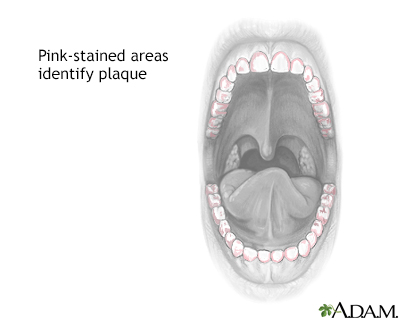 Multi-colour disclosing of dental plaque. Left: clinical image showing