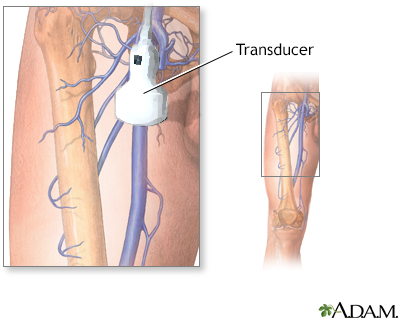 Doppler ultrasonography of an extremity - Illustration Thumbnail              