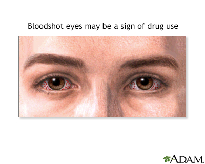 pinpoint pupils meaning drugs