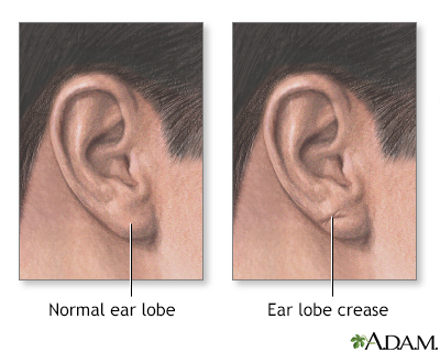 Ear lobe crease - Illustration Thumbnail
              