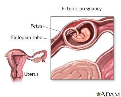 Ectopic pregnancy Information