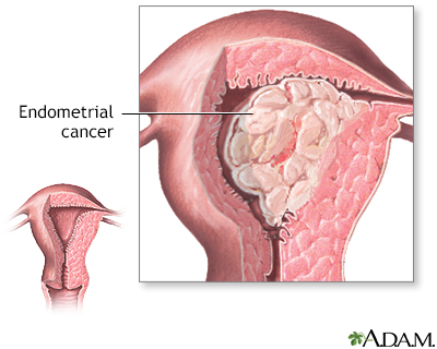 The tissue from Case 1, open and showing blood clots and endometrium