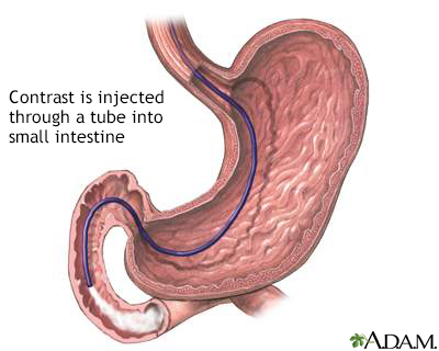 Small intestine contrast injection - Illustration Thumbnail
              