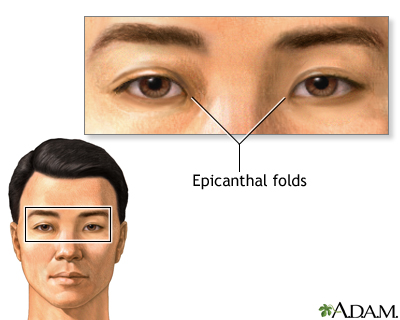 epicanthal fold fetal alcohol syndrome