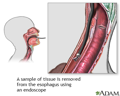 Esophageal tissue culture - Illustration Thumbnail
              