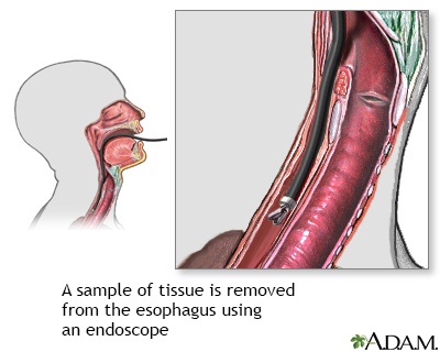 Esophageal tissue culture - Illustration Thumbnail
                      