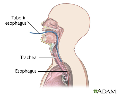 Esophageal pH monitoring - Illustration Thumbnail
              