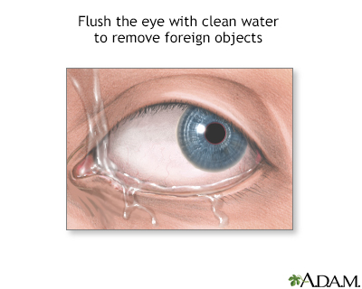 Foreign objects in eye - Illustration Thumbnail
                      