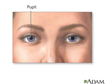 Anisocoria Information  Mount Sinai - New York