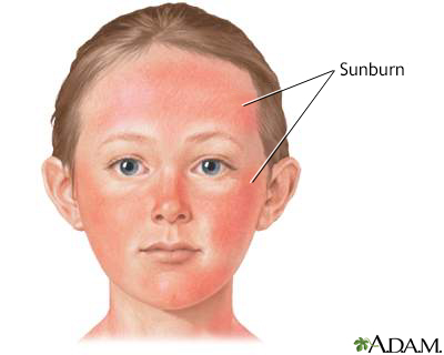 What's the best way to protect kids' skin from sunburn? 