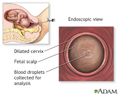 Fetal scalp pH testing Information