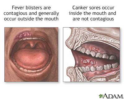 Cause for canker sores