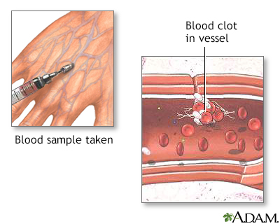 Blood clots - Illustration Thumbnail
              