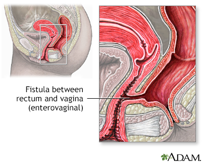 fistula symptoms