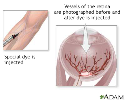 Retinal dye injection - Illustration Thumbnail							