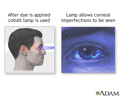 Fluorescent eye test - Illustration Thumbnail
              