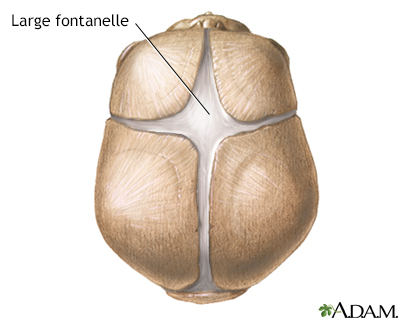 Large fontanelles