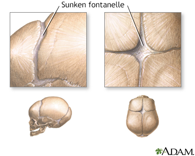 Sunken fontanelles (superior view) - Illustration Thumbnail
              