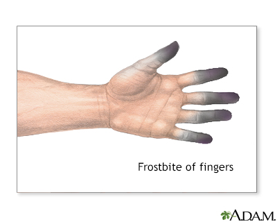 frostbite finger