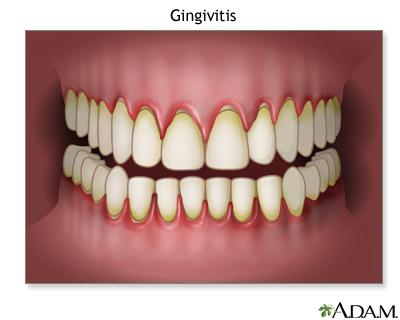 herpetic gingivostomatitis gums