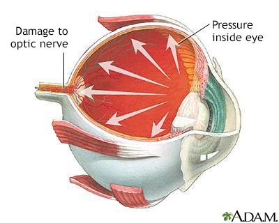 glaucoma eye vs normal eye