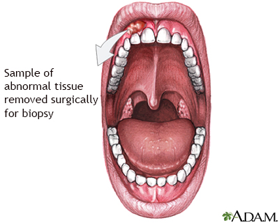 Gum biopsy - Illustration Thumbnail
              