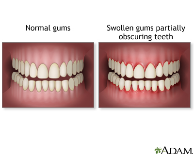 Swollen gums - Illustration Thumbnail              