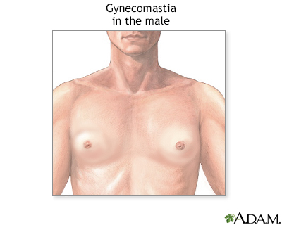 Gynecomastia - Illustration Thumbnail              