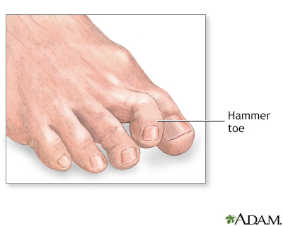 Hammer toe - Illustration Thumbnail
                      