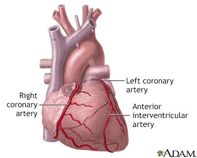 heart attack pain location. A heart attack (myocardial