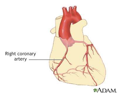 Coronary artery disease - Illustration Thumbnail
              
