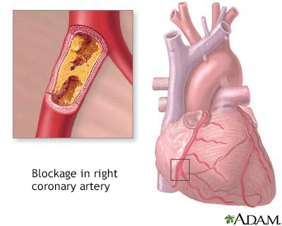 Coronary artery blockage - Illustration Thumbnail
                      