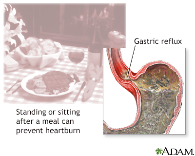 Heartburn prevention - Illustration Thumbnail
              