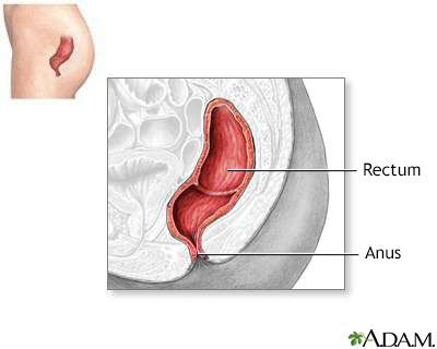 Proctitis Information Mount Sinai New York